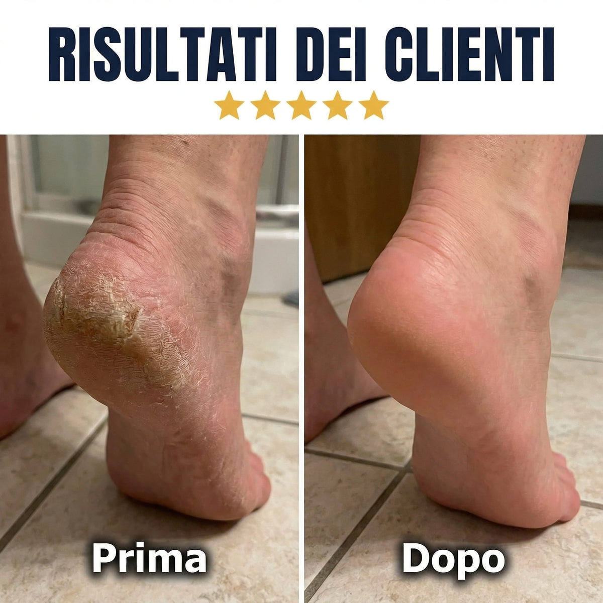 PediEase V2™ - Ritrova piedi morbidi come nuovi in 5 minuti